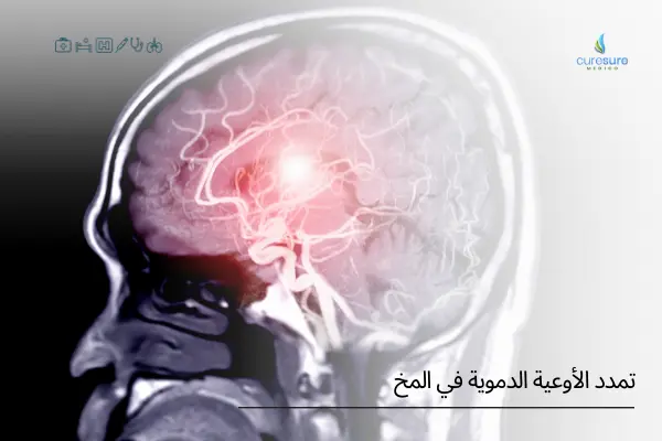 تمدد الأوعية الدموية في المخ ما هو وفهمه