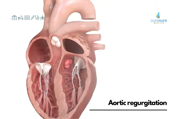 Understanding Aortic Regurgitation Causes Symptoms And Management 0591