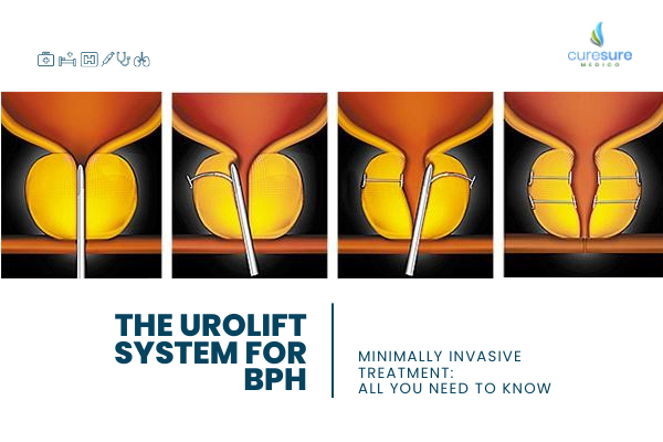 The UroLift System for BPH