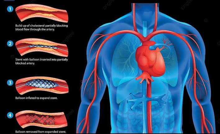Angioplasty and coronary stenting