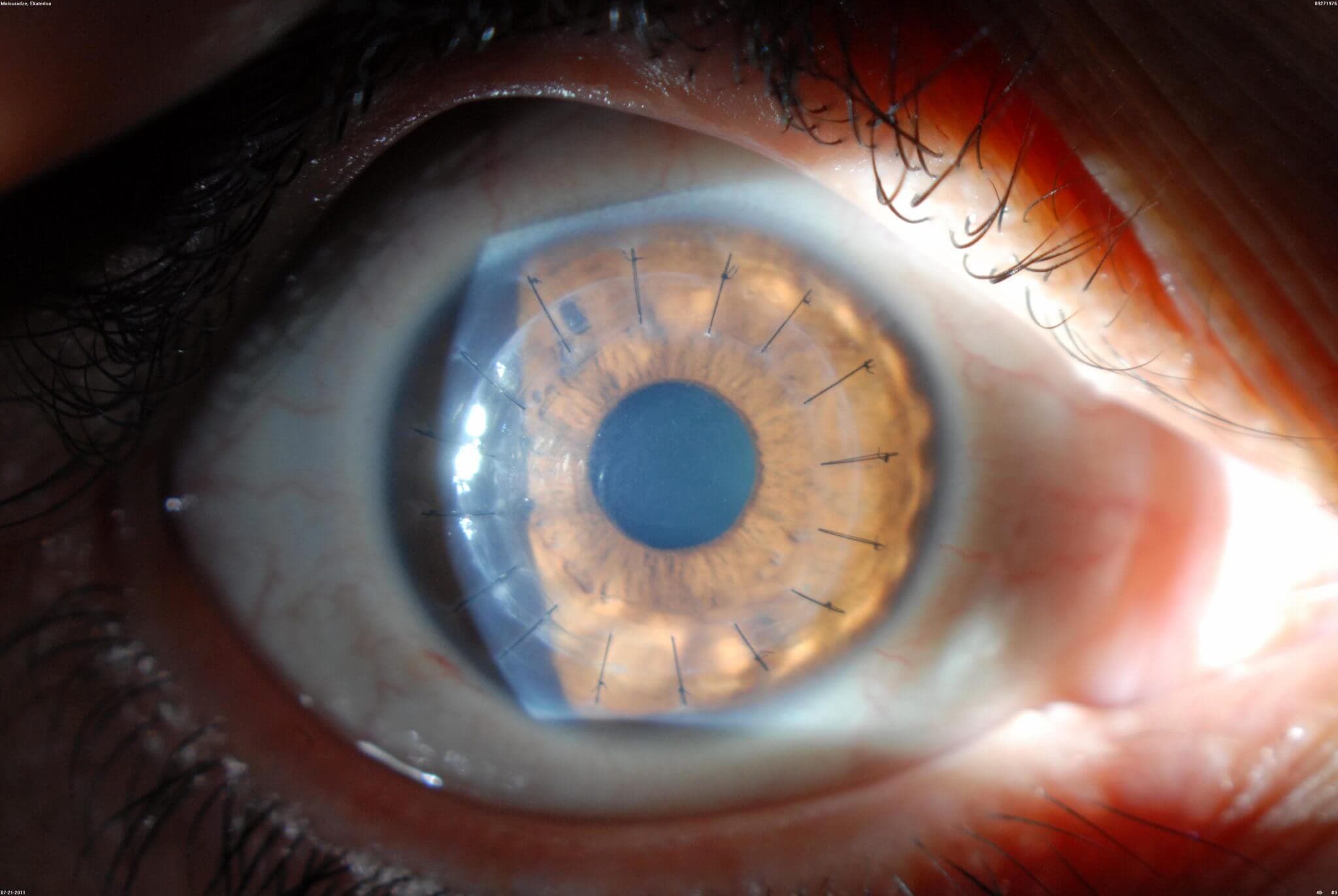 Corneal Transplant (Ophthalmic)