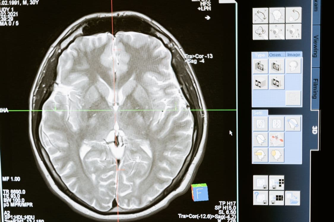 Deep Brain Stimulation