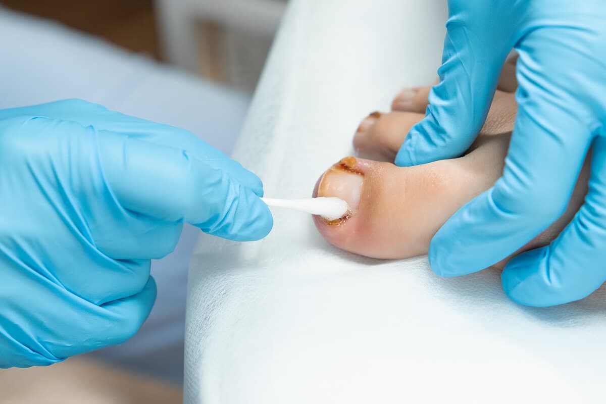 Diabetic Foot Care & Limb Salvage