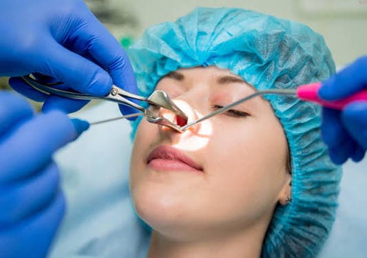 Functional Endoscopic Sinus Surgery (FESS)