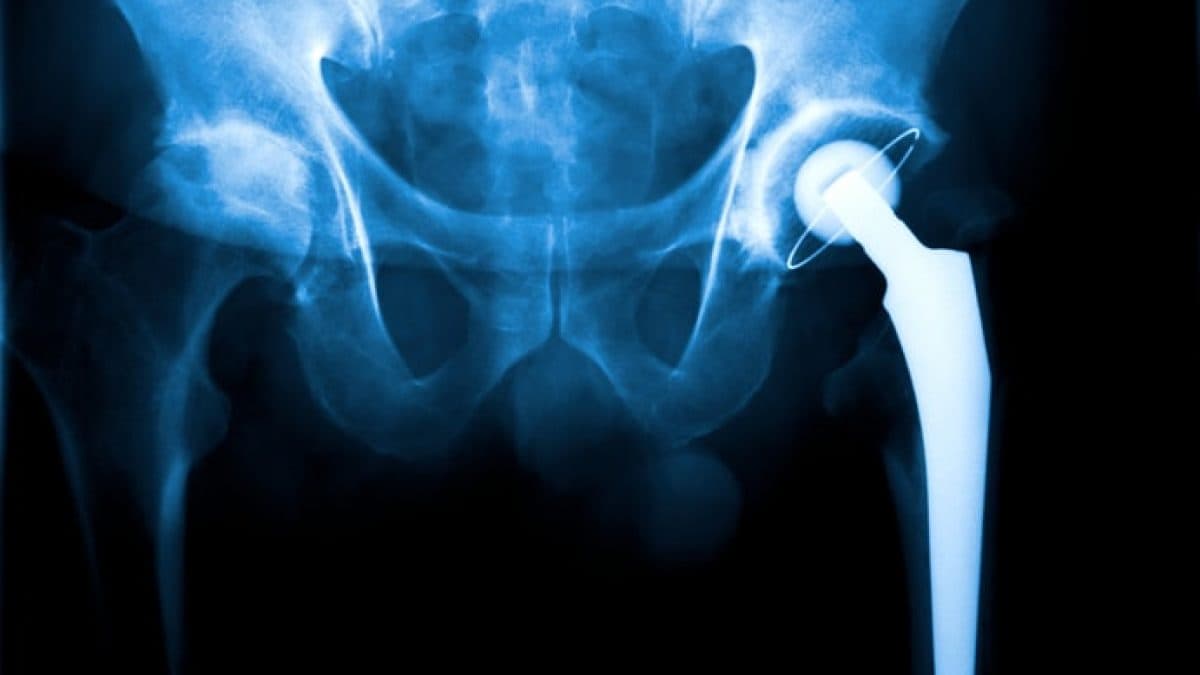 Hip Replacement (Including Robotic-Assisted)