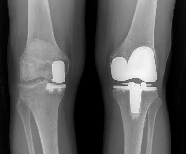 Knee Replacement (Total & Partial)
