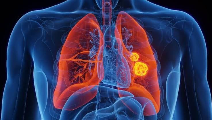 Lung Cancer Treatment