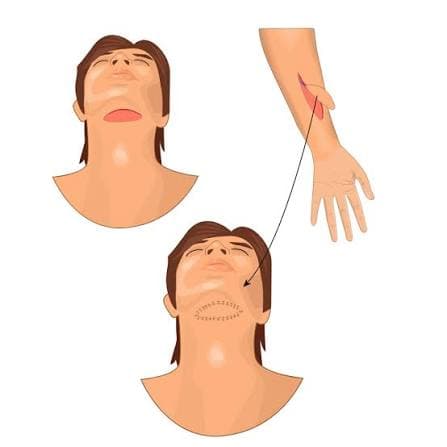 Microvascular and Free-Flap Reconstruction