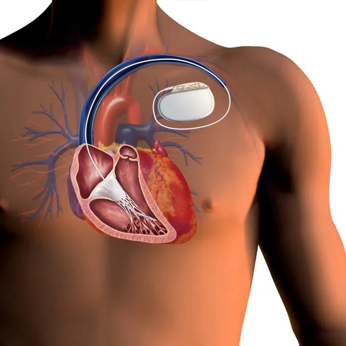Pacemaker and ICD implantation