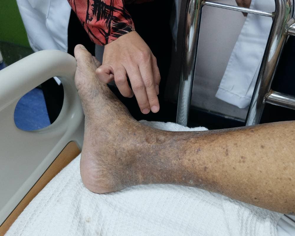 Peripheral Artery Disease Treatment