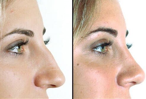 Septoplasty and Rhinoplasty