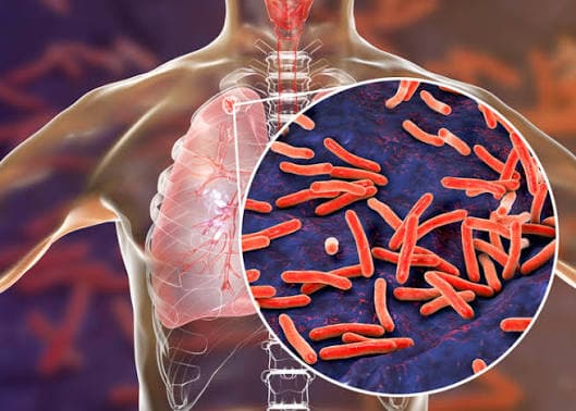 Tuberculosis Treatment