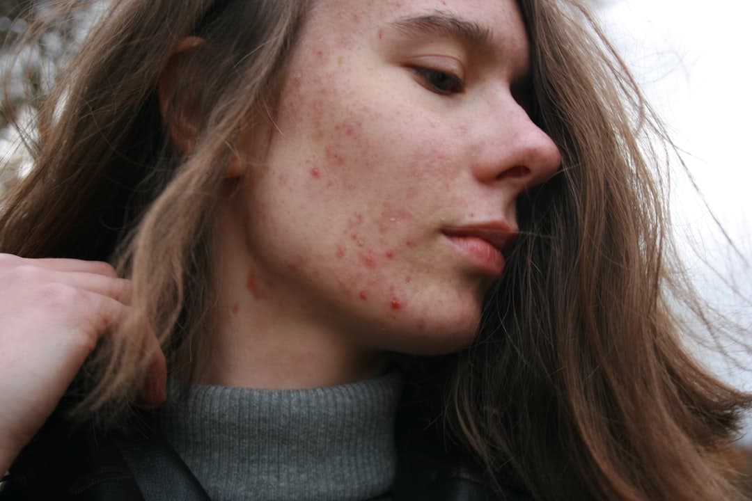 Autoimmune Skin Disorder Treatment
