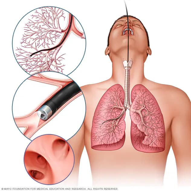 Interventional Bronchoscopy