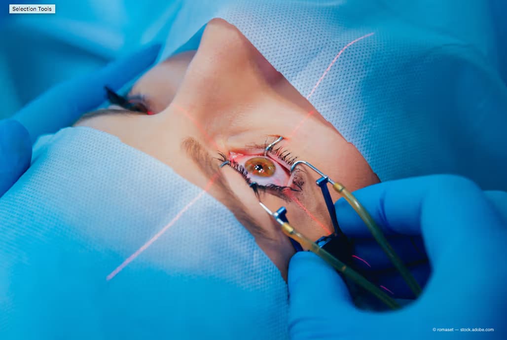 Cataract Surgery