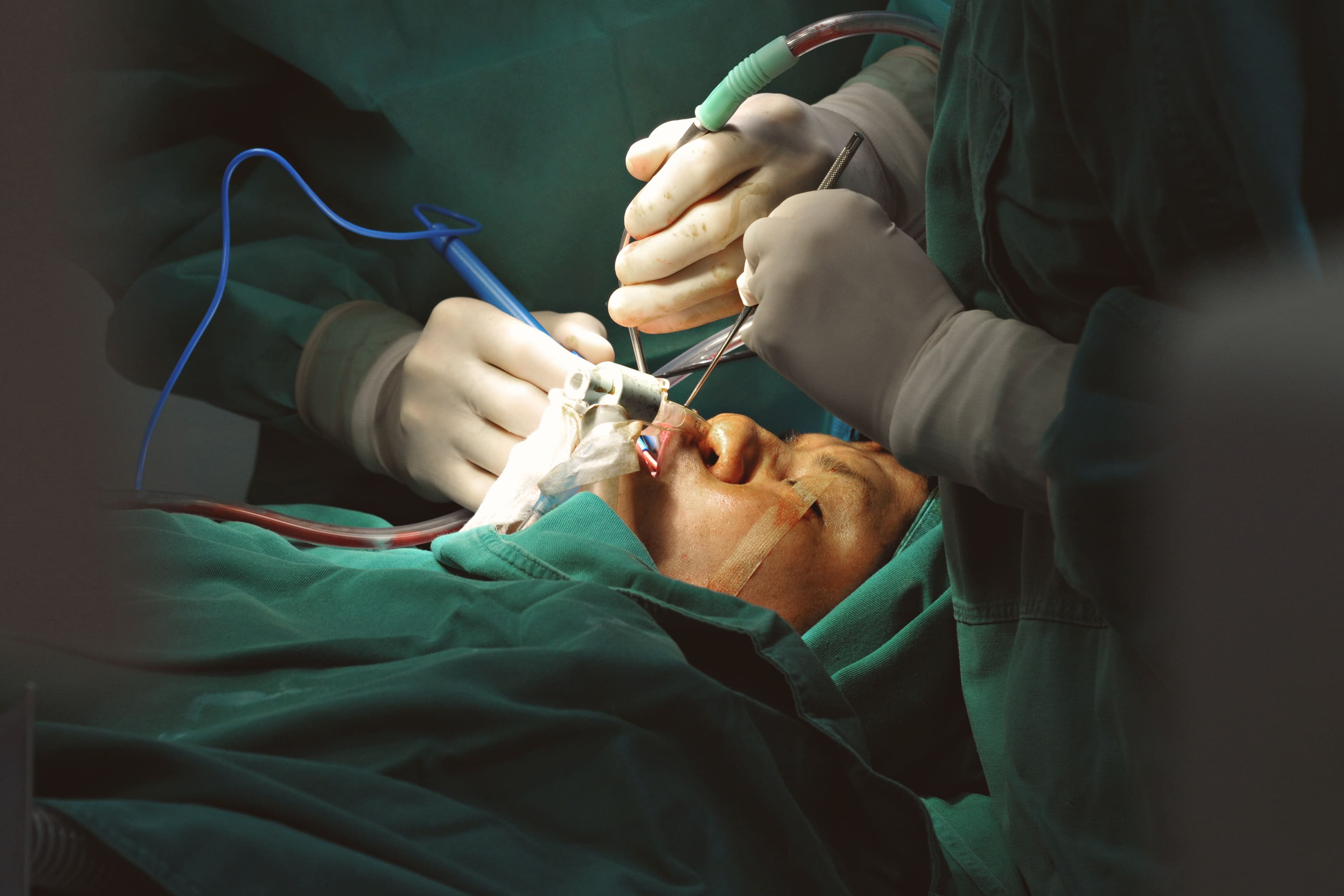 Cleft Lip and Palate Repair