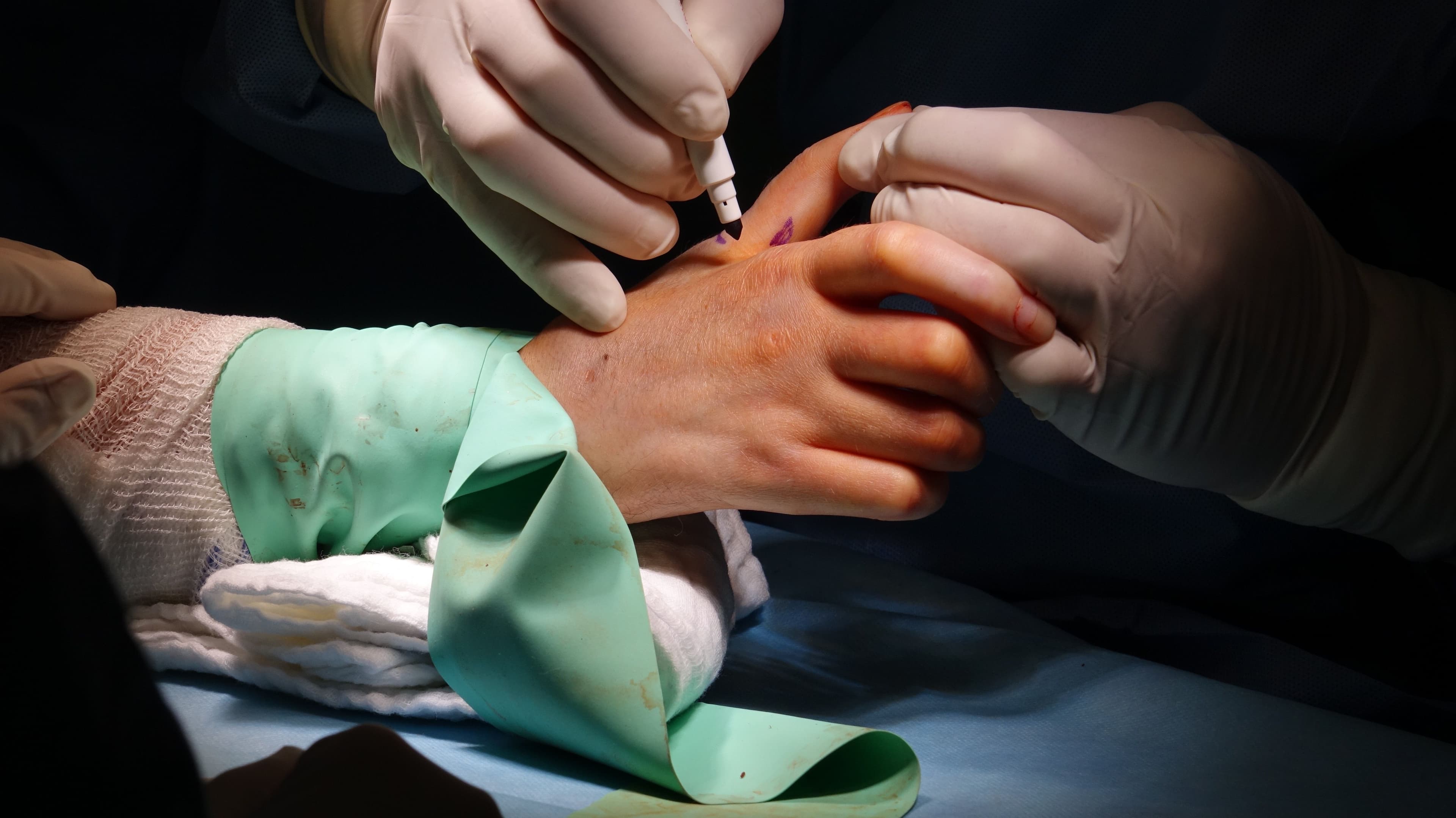 Hand Surgery and Reattachment