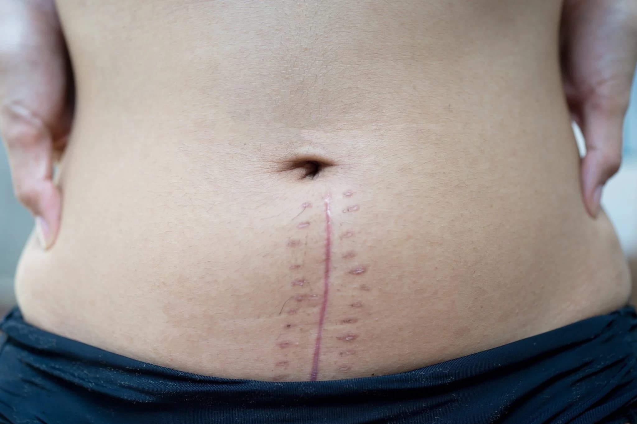 Hysterectomy