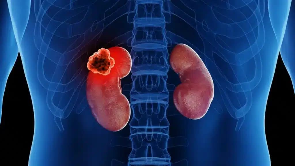 Kidney (Renal) Cancer Treatment