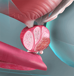 Bladder & Prostate Cancer Treatment