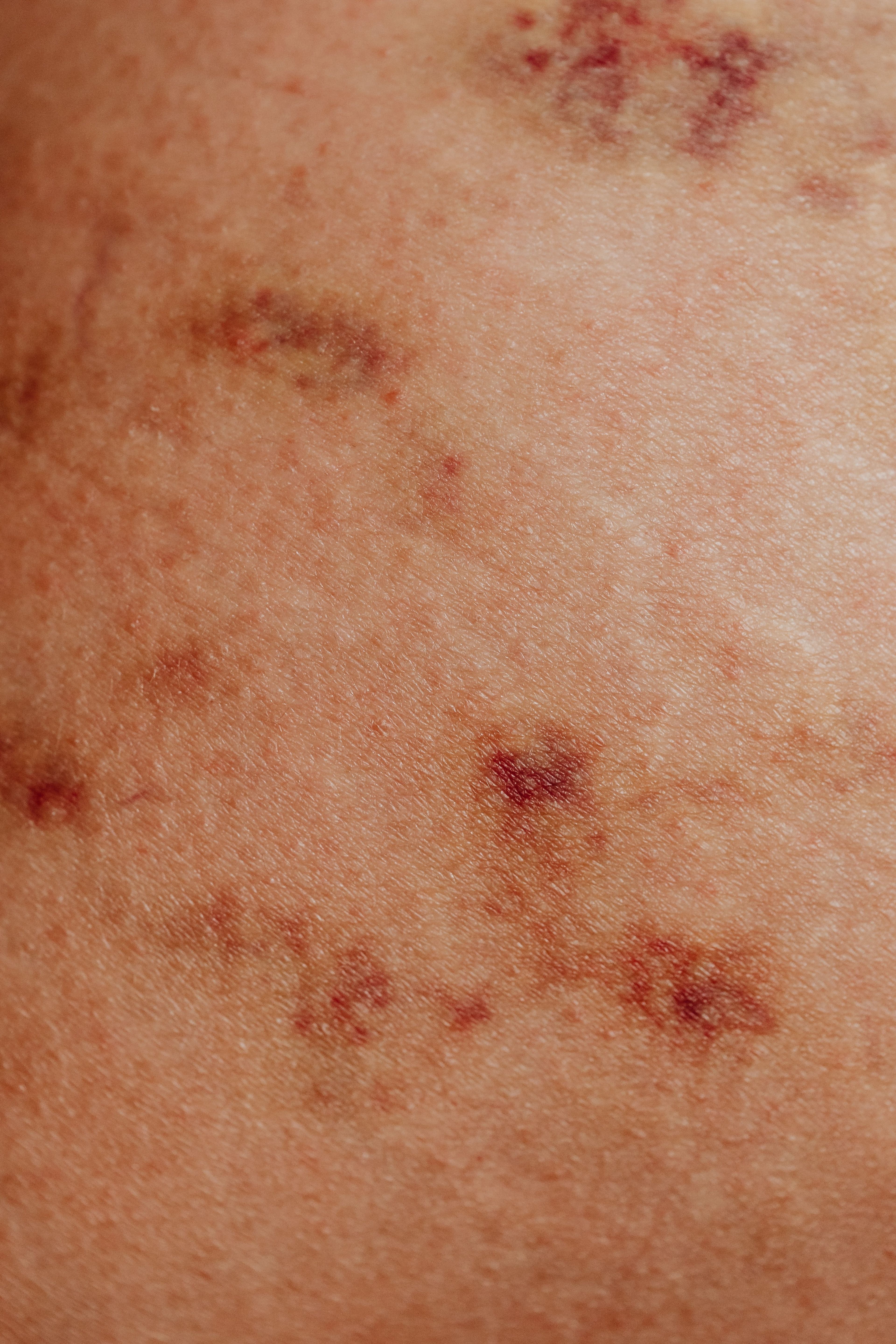 Psoriasis & Eczema Management