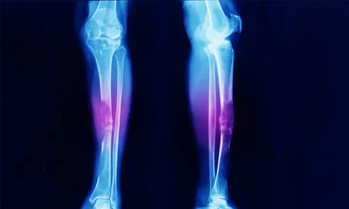 Sarcoma — Bone & Soft Tissue Cancer Treatment