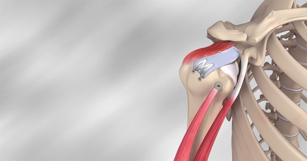 Shoulder Replacement & Arthroscopy
