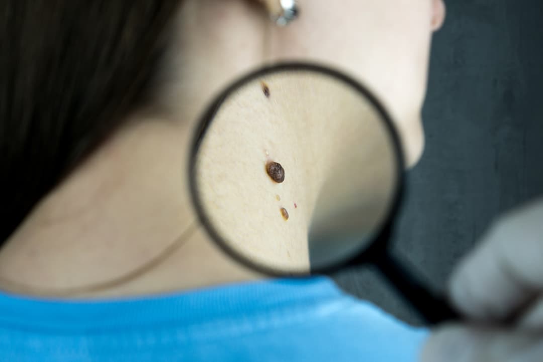 Skin Cancer Diagnosis & Surgical Removal