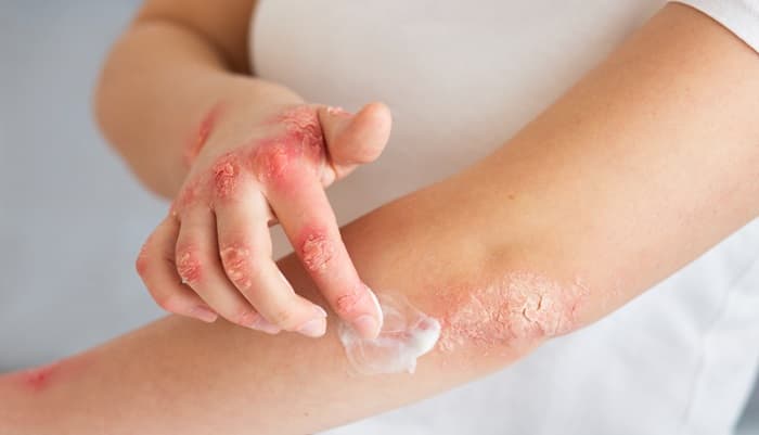Burn Reconstruction and Skin Grafting
