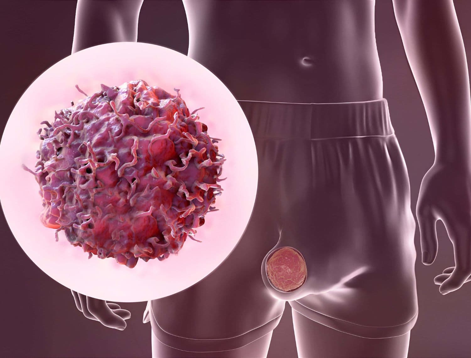 Testicular Cancer Treatment