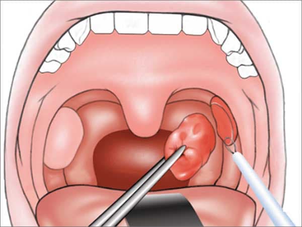 Tonsillectomy and Adenoidectomy