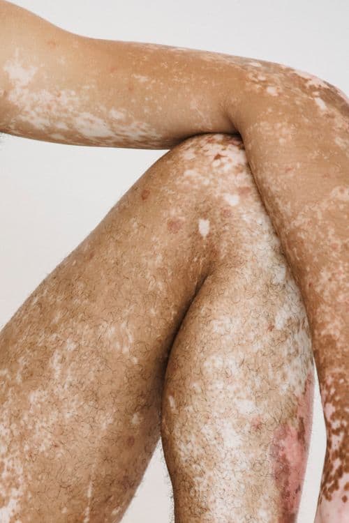 Vitiligo & Pigmentation Treatment