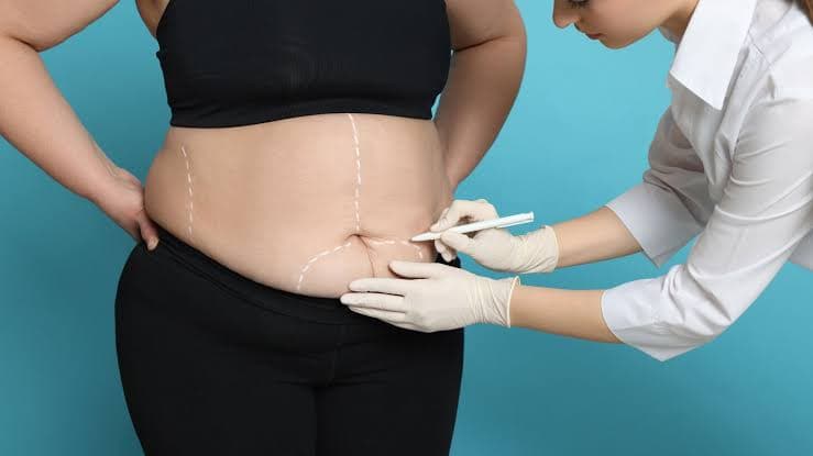 Bariatric Surgery